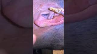 ear wax removal