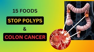 15 Superfoods to Prevent Colon Polyps and Bowel Cancer