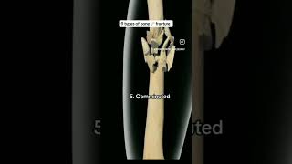 9 type of bone fracture#anatomy#physiotherapy #doctor #humanbody #viralreels #fracture #information