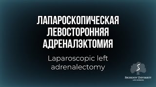 Лапароскопическая левосторонняя адреналэктомия / Laparoscopic left adrenalectomy