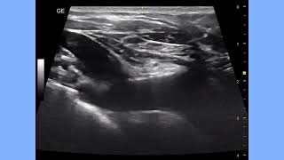 Internal Jugular Vein Valves, ultrasound imaging and sonography