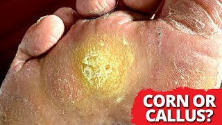 Corn? Or Callus??