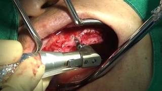 Lateral bone augmentation with BOSS 1