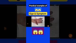 practical examples of sign & symptom #viralvideo #shortsviralvideo #shorts