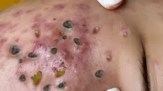 Big Cystic Acne Blackheads Extraction Blackheads & Milia, Whiteheads Removal Pimple Popping