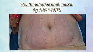 CO2 laser treatment of stretch marks || स्किन में पड़ने वाले स्ट्रेच मार्क्स से ऐसे पाएं छुटकारा