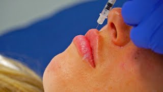 Lip Injections For Fuller Plumper Lips Here At Blue Diamond Med Spa In San Antonio, Texas!