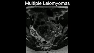 Multiple Leiomyomas