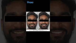 Virtual Smile Designing @kosmodentalacademy #dtspro #veneers #dentalacademy #hyderabad