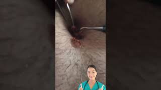 Dr.Natacha, removal satisfying video.