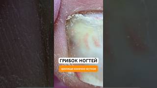 Эффективное средство от грибка ногтей. Артикул - 67774905