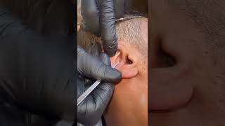 blackheads in ear