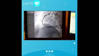 Direct stenting