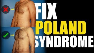 What is Poland Syndrome in Men?