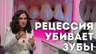 Рецессия (опущение) десны — причины и как с этим бороться. Клиновидный дефект не то, чем кажется