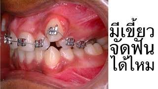 จัดฟันต้องถอนเขี้ยวไหม (High Canine Teeth! Braces)