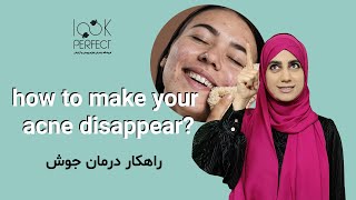 How to make your acne disappear? | راهکار درمان جوش