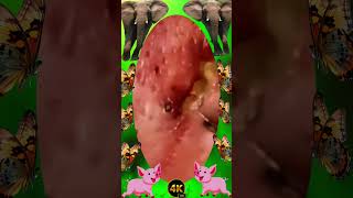 Big Cystic Acne Blackheads Extraction Blackheads & Milia, Whiteheads Removal Pimple Popping #PA154