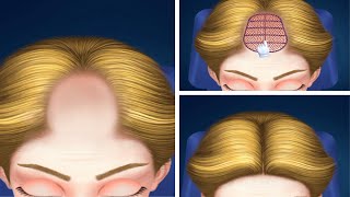 Asmr A girl's head hair has gone out and how to surgery #mrnajeebideas