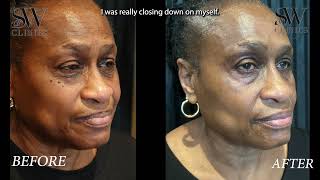 Fatima's Non-Surgical Blepharoplasty Testimonial with English Subtitles | DR SW Clinics