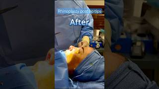 Rhinoplasty recovery tips for healing #bergencounty #njplasticsurgeon #nosejobbeforeandafter #lipo