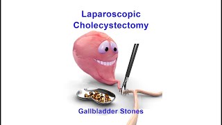 Laparoscopic Cholecystectomy (Lap Chole for Gallbladder with Stones)