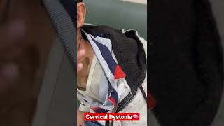 Cervical Dystonia🧠 #retrocollis #laterocollis #dystonia #neurology #viral #trending #shorts #botox￼