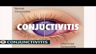 Conjunctivitis: Diagnosis, Symptoms, Treatment and Prevention by Saidat Sododo