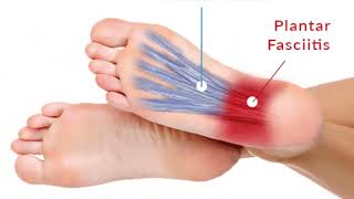 Plantar Fasciitis l Causes/Risk factors, symptoms & treatmentl