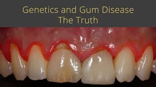 Genetics and Gum Disease