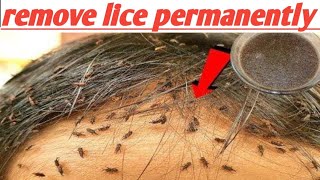 How to Get Rid of Lice Permanently in 1 Hour - Home Remedies to Get Rid of Lice Eggs in Hair