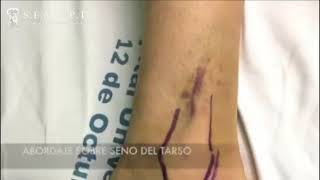 3. FRACTURA INTRAARTICULAR DE CALCANEO. TECNICA MIPO. IMPRESION 3D (SEMCPT)