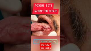 #shorts #youtubeshorts Tongue Bite Laceration Repair