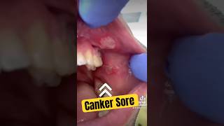 Canker Sore , mouth ULCERS