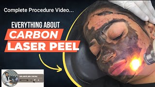 Carbon laser peel: Video Demonstration @designerdoc #carbonpeel #carbonlaserpeel #hollywoodpeel