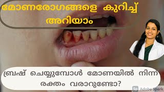 #Gumdisease ബ്രഷ്ചെയ്യുമ്പോൾ മോണയിൽ നിന്ന് രക്തം വരാറുണ്ടോ?|Dr. Anagha Cheleri