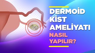 Dermoid Kist Ameliyatı Nasıl Yapılır? Dermoid Kistlerin Ameliyatı Hakkında Merak Edilenler