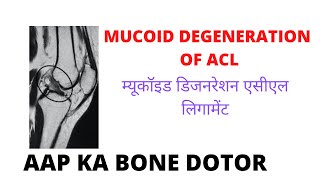 MUCOID DEGENERATION OF ACL- EPISODE 17