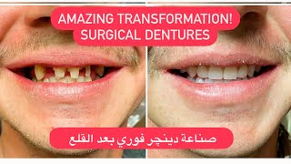 LIFE CHANGING SURGICAL DENTURES. صناعة دينچر جراحي او فوري. نتيجة رهيبة (Phone friendly) #WAXBAE