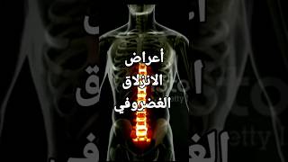 احذر من هذه الأعراض - فقد تكون مصاب بانزلاق غضروفي #shorts