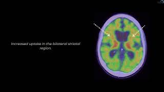 Beta Amyloid Vizamyl PET/CT Case 5