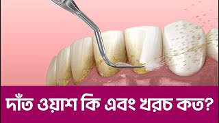 দাঁত ওয়াশ কি এবং খরচ কত ।। Tech Dental