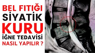 SİYATİK BEL FITIĞI KURU İĞNE TEDAVİSİ NASIL YAPILIR ?