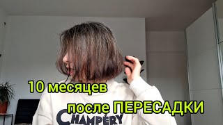 10 мес ПОСЛЕ ПЕРЕСАДКИ ВОЛОС в Турции. Облысение по мужскому типу