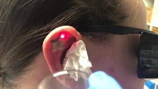 Laser tattoo removal on ear tattoo