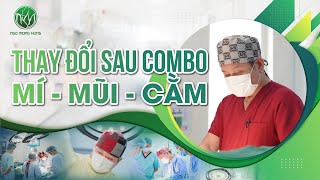 Thay Đổi Sau Combo Mí Mũi Cằm  | Bác Sĩ Ngô Mộng Hùng #ngomonghung