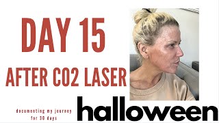 15 days after CO2 Laser- its HALLOWEEN!!!!!