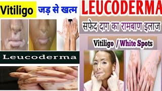 Leucoderma Best Homoeopathic Medicine Combination//Vitiligo Best Medicines //HM4U Roorkee//By: Y.K .