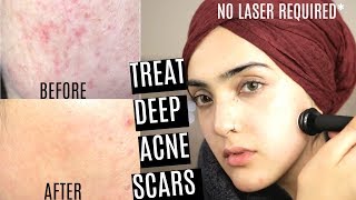 How To Remove Deep Ance Scars/Hyperpigmentation (MICRONEEDLING AT HOME)~ Immy