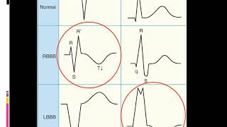 EKG Itu Gampang Sesi 6 (Latihan Aritmia Lanjutan)